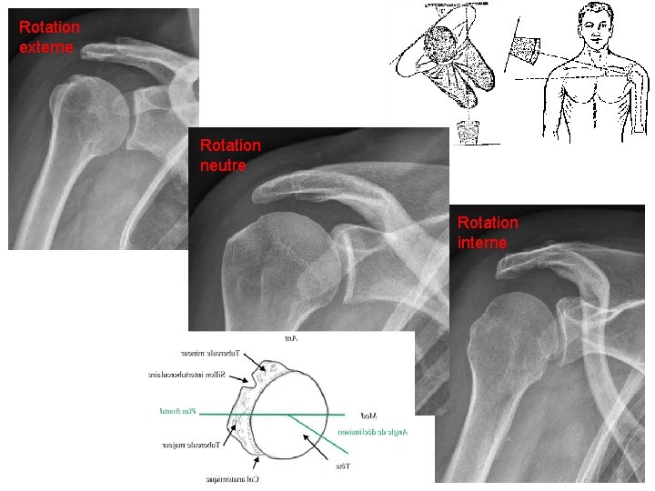 Rotation externe Rotation neutre Rotation interne 