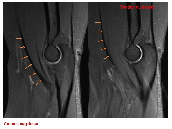 Tendon du biceps Coupes sagittales 