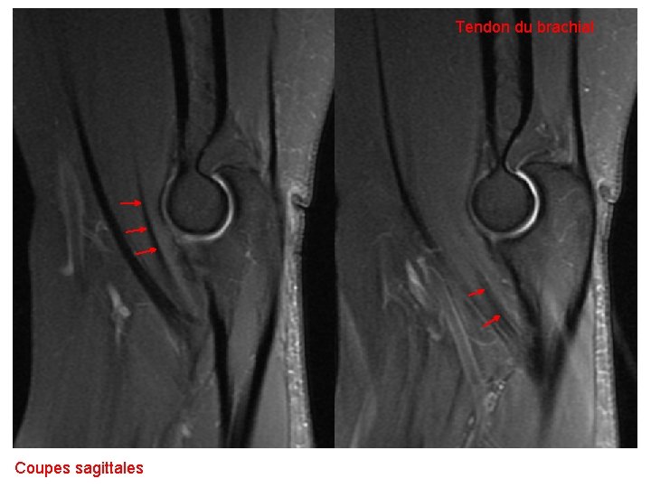 Tendon du brachial Coupes sagittales 