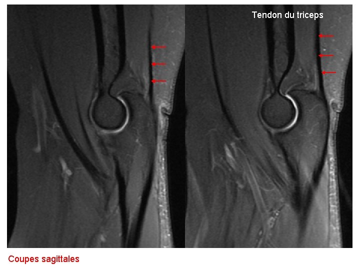 Tendon du triceps Coupes sagittales 