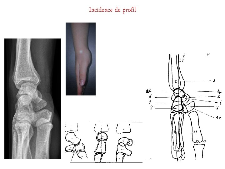 Incidence de profil 