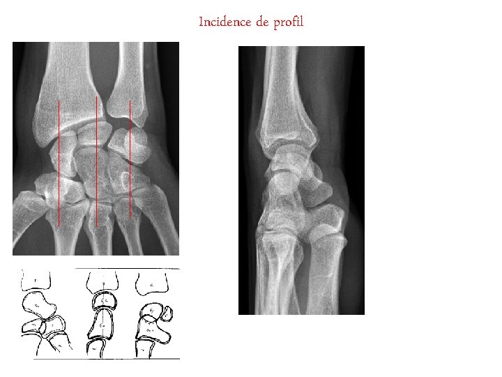 Incidence de profil 