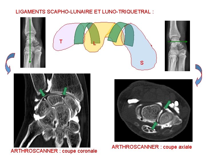 LIGAMENTS SCAPHO-LUNAIRE ET LUNO-TRIQUETRAL : T L S ARTHROSCANNER : coupe coronale ARTHROSCANNER :