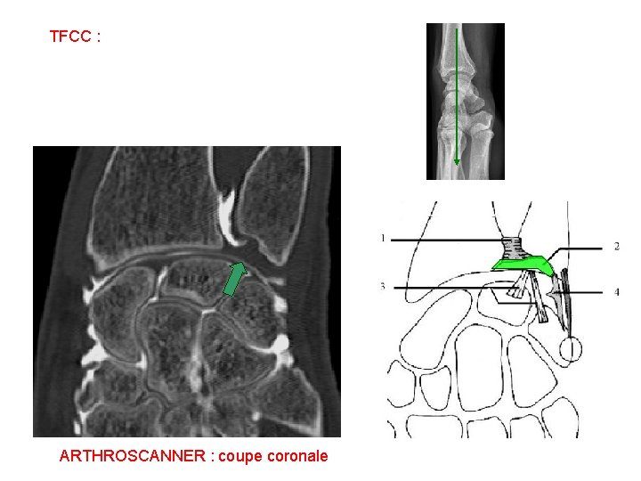 TFCC : ARTHROSCANNER : coupe coronale 