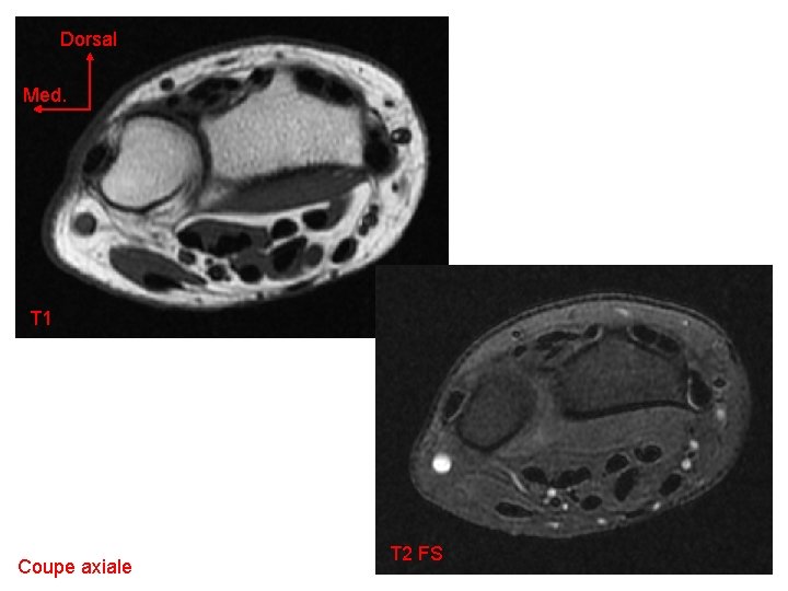 Dorsal Med. T 1 Coupe axiale T 2 FS 