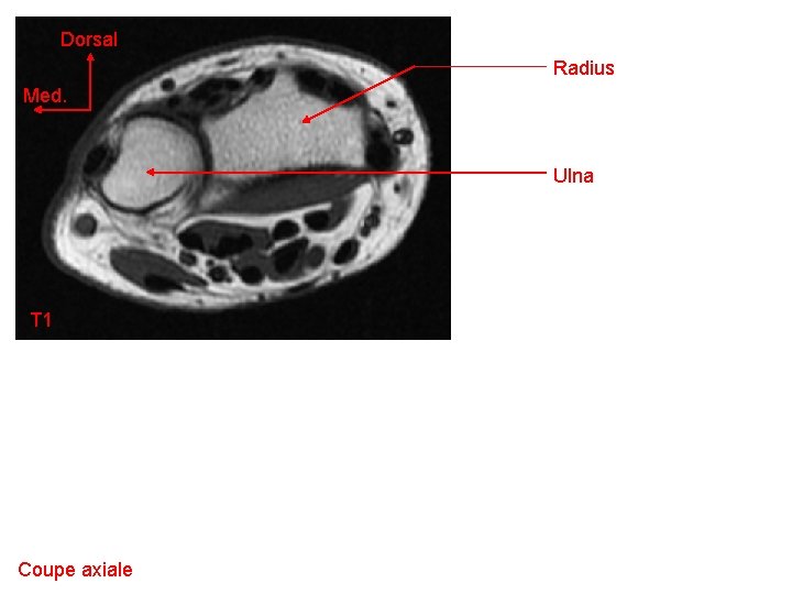 Dorsal Radius Med. Ulna T 1 Coupe axiale 