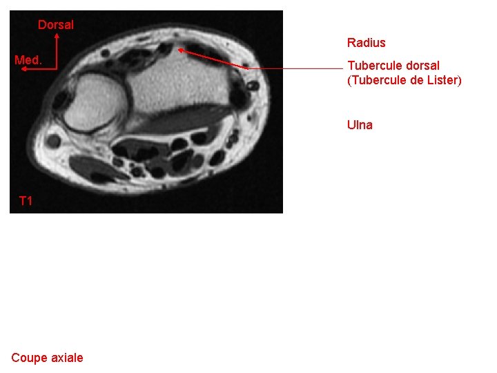 Dorsal Radius Med. Tubercule dorsal (Tubercule de Lister) Ulna T 1 Coupe axiale 