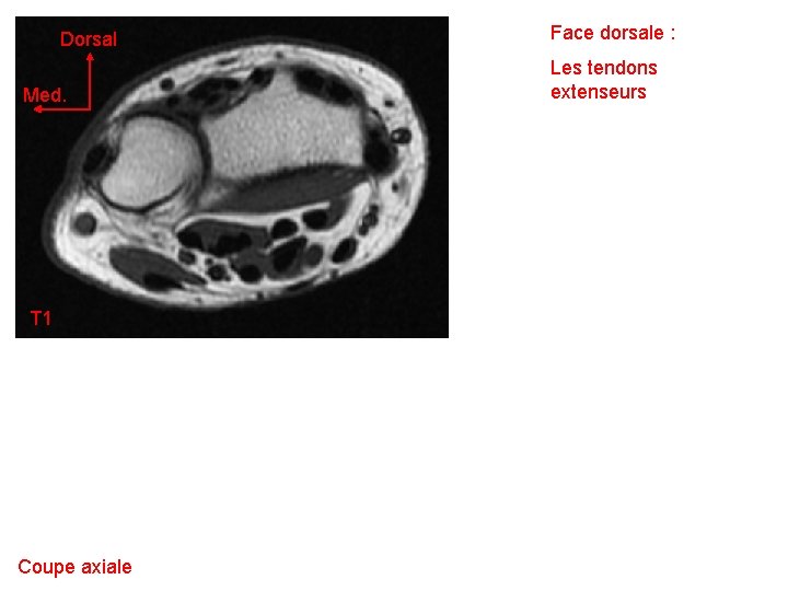 Dorsal Med. T 1 Coupe axiale Face dorsale : Les tendons extenseurs 