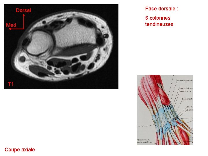 Dorsal Med. T 1 Coupe axiale Face dorsale : 6 colonnes tendineuses 