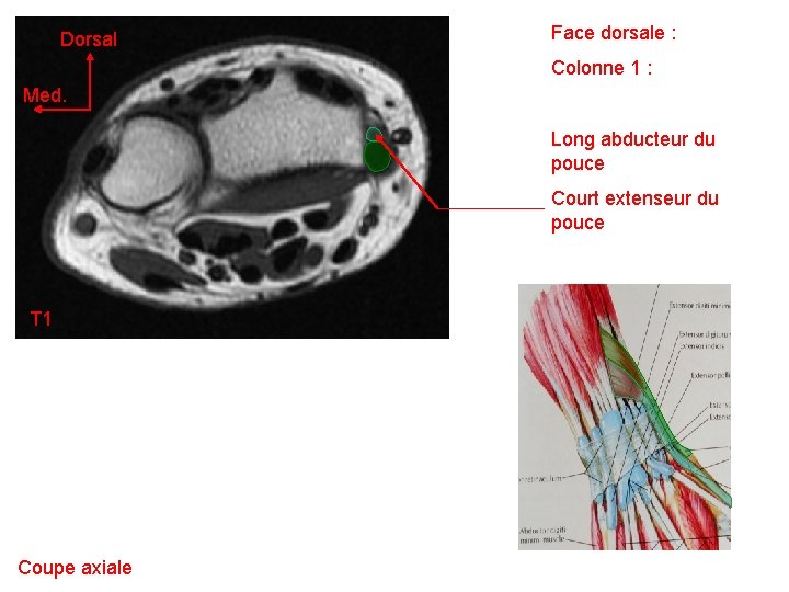 Dorsal Face dorsale : Colonne 1 : Med. Long abducteur du pouce Court extenseur