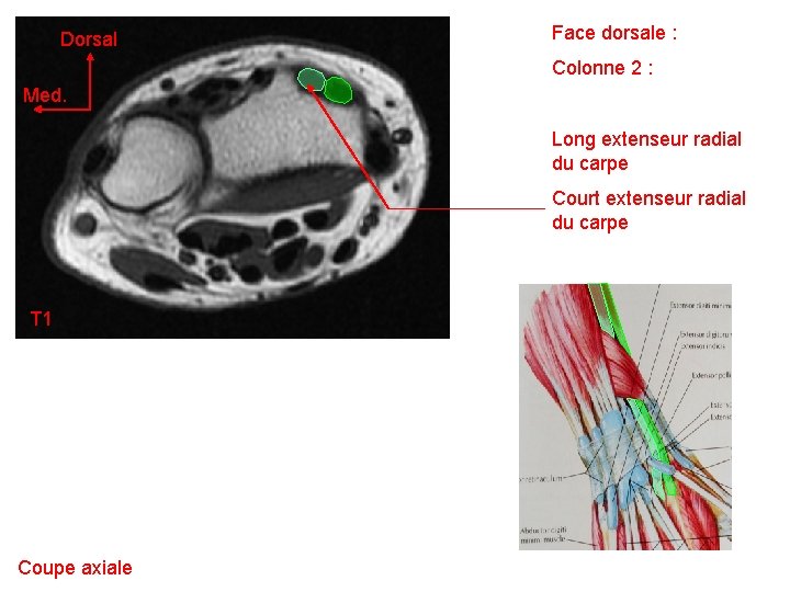Dorsal Face dorsale : Colonne 2 : Med. Long extenseur radial du carpe Court