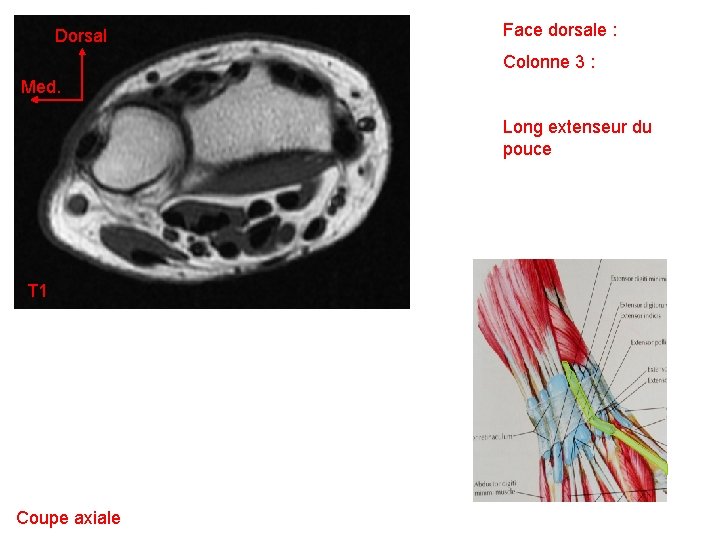 Dorsal Face dorsale : Colonne 3 : Med. Long extenseur du pouce T 1