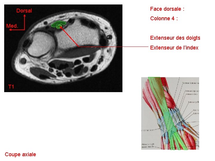 Dorsal Face dorsale : Colonne 4 : Med. Extenseur des doigts Extenseur de l’index