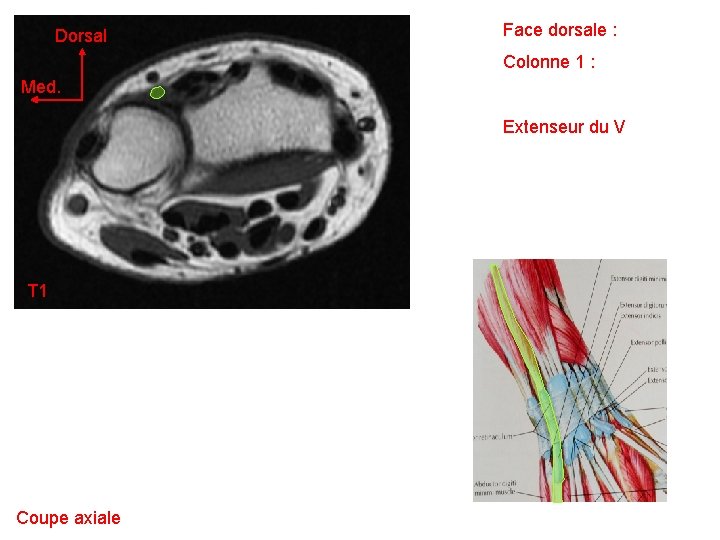 Dorsal Face dorsale : Colonne 1 : Med. Extenseur du V T 1 Coupe