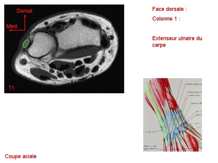 Dorsal Face dorsale : Colonne 1 : Med. Extenseur ulnaire du carpe T 1