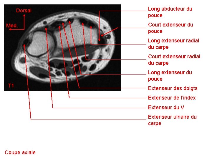 Dorsal Med. Long abducteur du pouce Court extenseur du pouce Long extenseur radial du