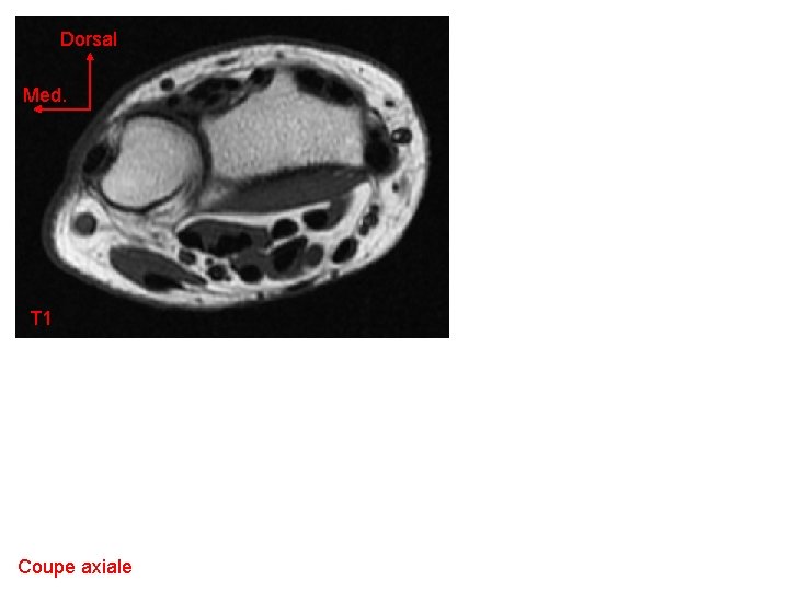Dorsal Med. T 1 Coupe axiale 