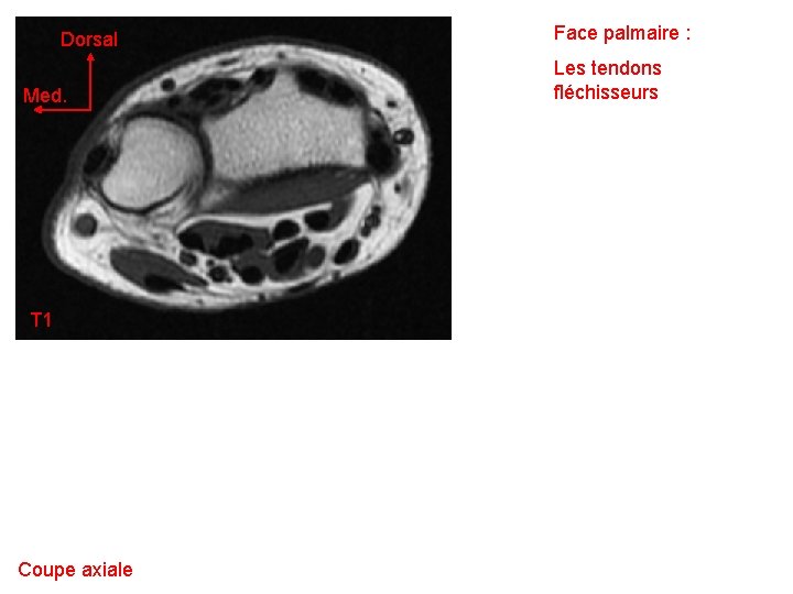 Dorsal Med. T 1 Coupe axiale Face palmaire : Les tendons fléchisseurs 