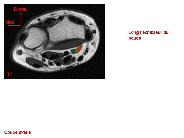 Dorsal Med. Long fléchisseur du pouce T 1 Coupe axiale 