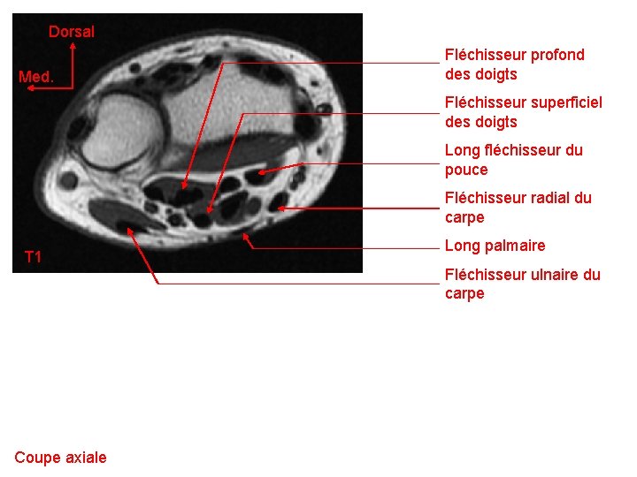 Dorsal Med. Fléchisseur profond des doigts Fléchisseur superficiel des doigts Long fléchisseur du pouce