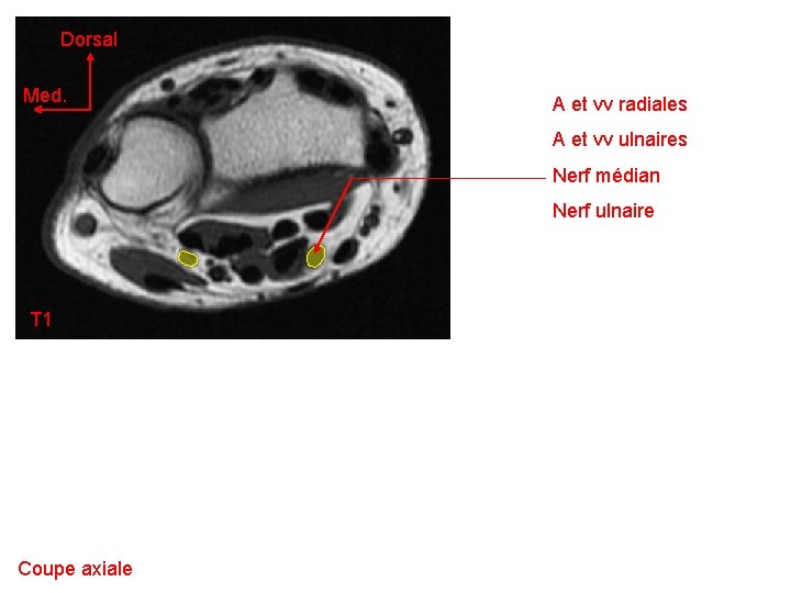 Dorsal Med. A et vv radiales A et vv ulnaires Nerf médian Nerf ulnaire