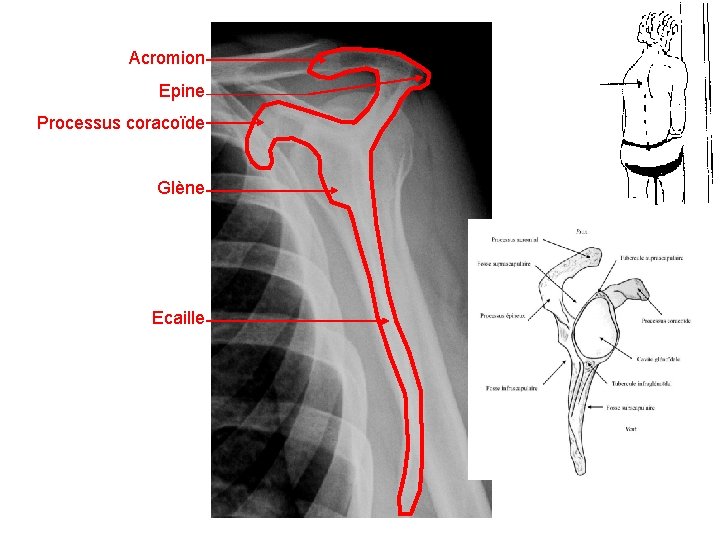 Acromion Epine Processus coracoïde Glène Ecaille 