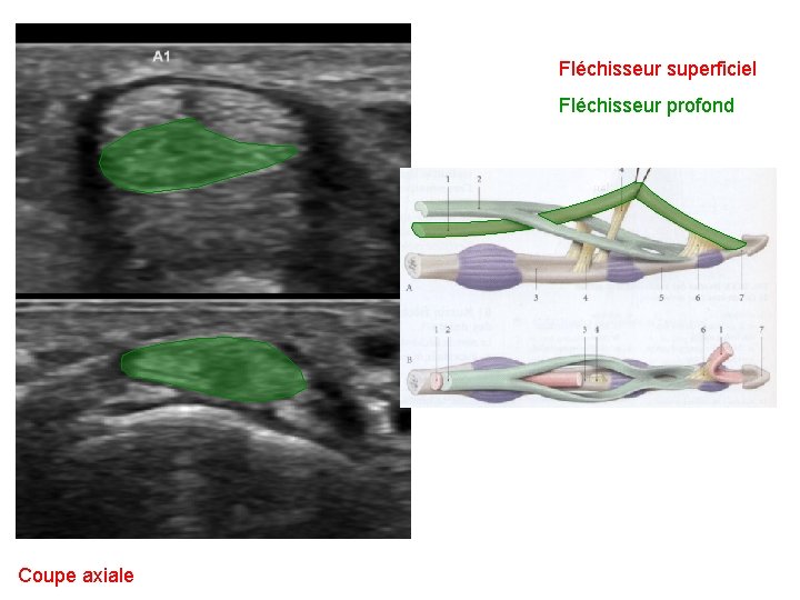 Fléchisseur superficiel Fléchisseur profond Coupe axiale 