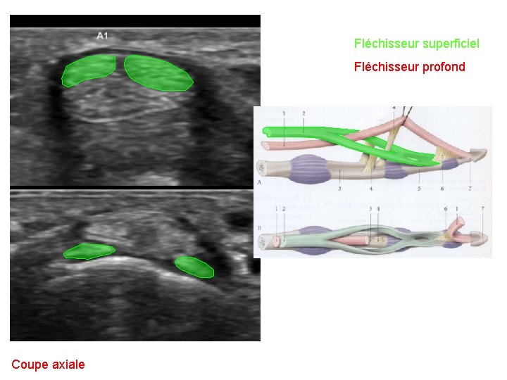 Fléchisseur superficiel Fléchisseur profond Coupe axiale 