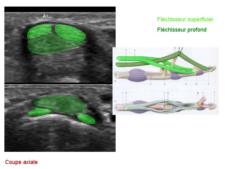 Fléchisseur superficiel Fléchisseur profond Coupe axiale 