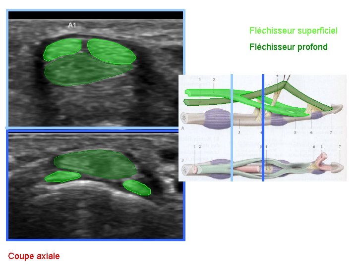 Fléchisseur superficiel Fléchisseur profond Coupe axiale 