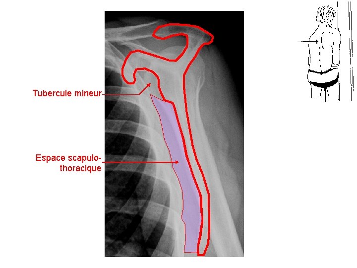 Tubercule mineur Espace scapulothoracique 