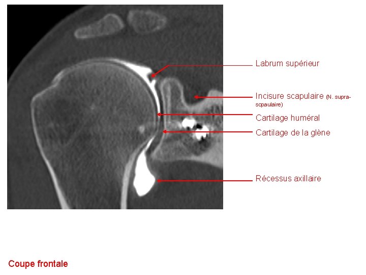 Labrum supérieur Incisure scapulaire (N. supra- scpaulaire) Cartilage huméral Cartilage de la glène Récessus