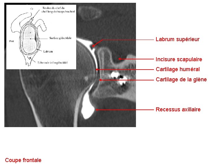 Labrum supérieur Incisure scapulaire Cartilage huméral Cartilage de la glène Recessus axillaire Coupe frontale
