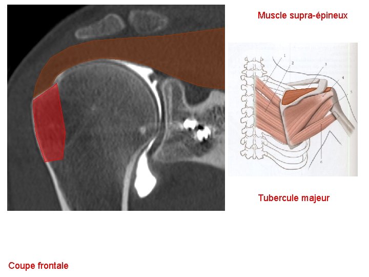 Muscle supra-épineux Tubercule majeur Coupe frontale 