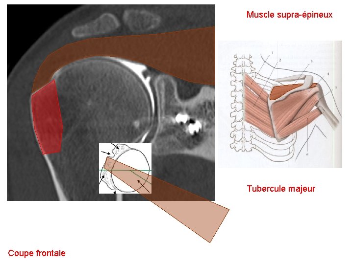 Muscle supra-épineux Tubercule majeur Coupe frontale 