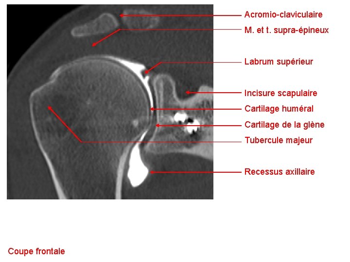 Acromio-claviculaire M. et t. supra-épineux Labrum supérieur Incisure scapulaire Cartilage huméral Cartilage de la