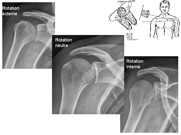 Rotation externe Rotation neutre Rotation interne 