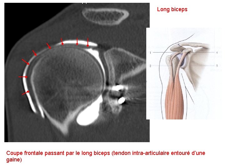 Long biceps Coupe frontale passant par le long biceps (tendon intra-articulaire entouré d’une gaine)