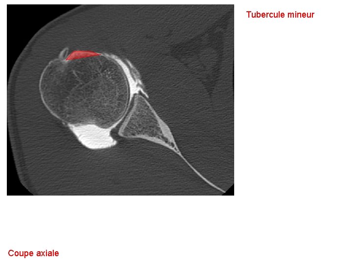 Tubercule mineur Coupe axiale 