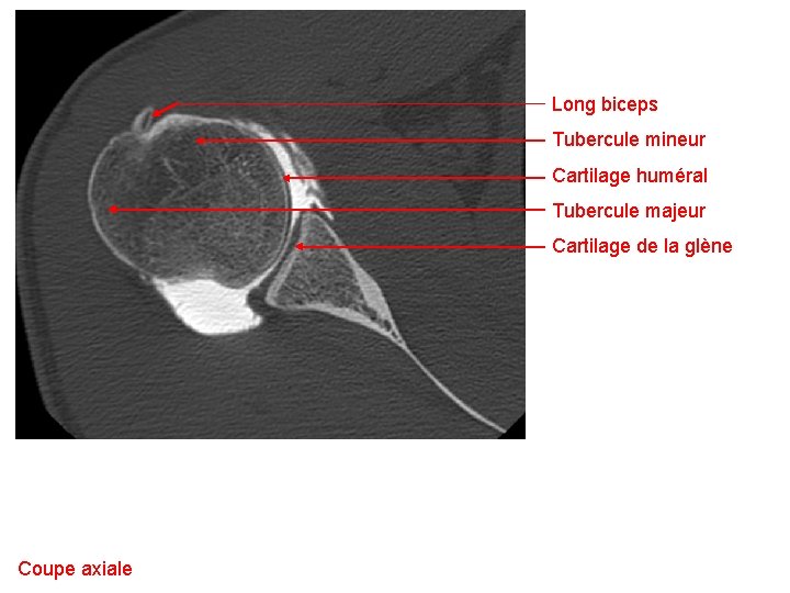 Long biceps Tubercule mineur Cartilage huméral Tubercule majeur Cartilage de la glène Coupe axiale