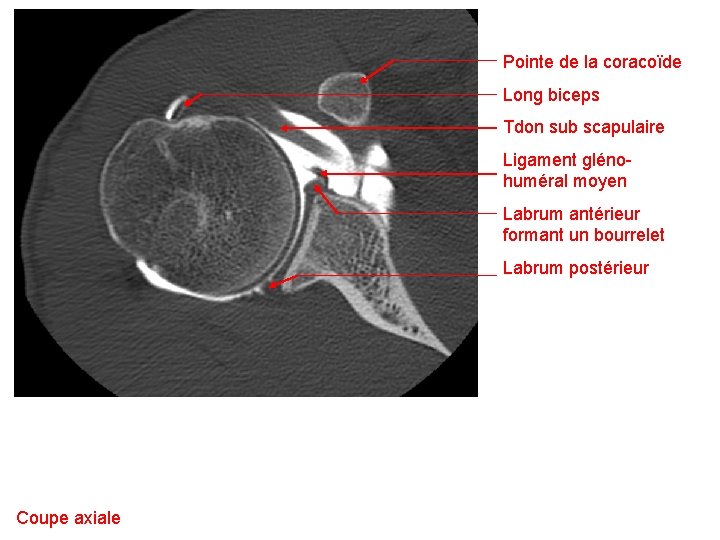 Pointe de la coracoïde Long biceps Tdon sub scapulaire Ligament glénohuméral moyen Labrum antérieur