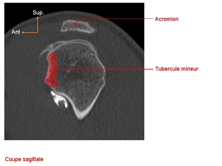 Sup. Acromion Ant. Tubercule mineur Coupe sagittale 