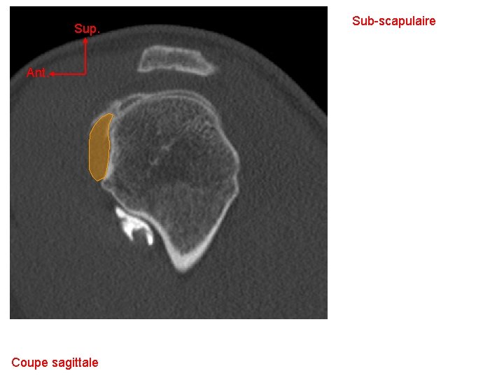 Sup. Ant. Coupe sagittale Sub-scapulaire 