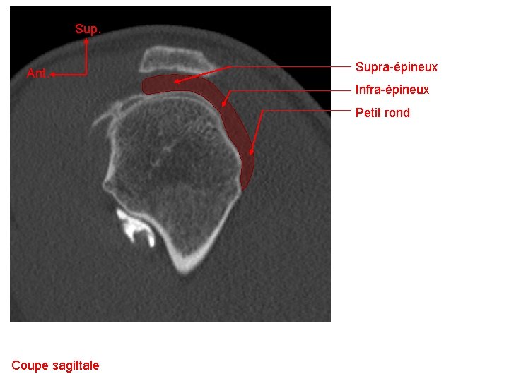 Sup. Ant. Supra-épineux Infra-épineux Petit rond Coupe sagittale 