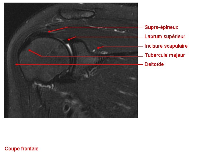 Supra-épineux Labrum supérieur Incisure scapulaire Tubercule majeur Deltoïde Coupe frontale 