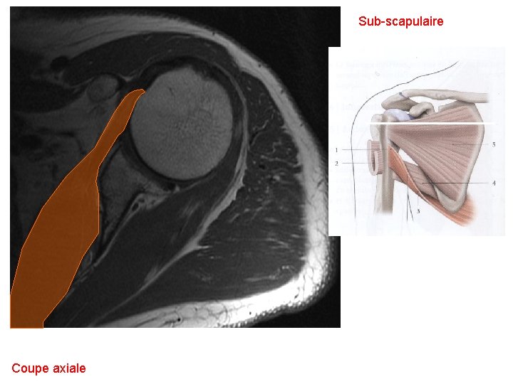 Sub-scapulaire Coupe axiale 