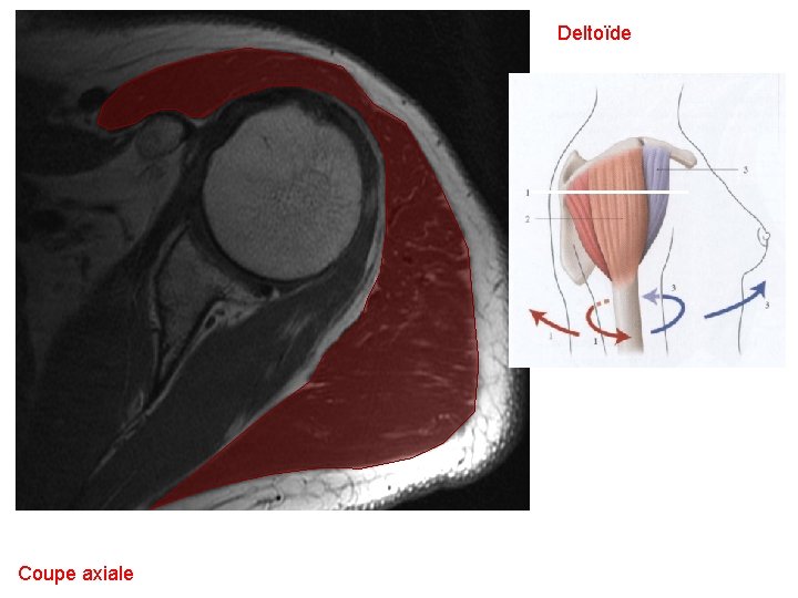 Deltoïde Coupe axiale 