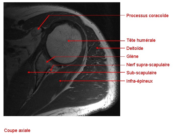 Processus coracoïde Tête humérale Deltoïde Glène Nerf supra-scapulaire Sub-scapulaire Infra-épineux Coupe axiale 