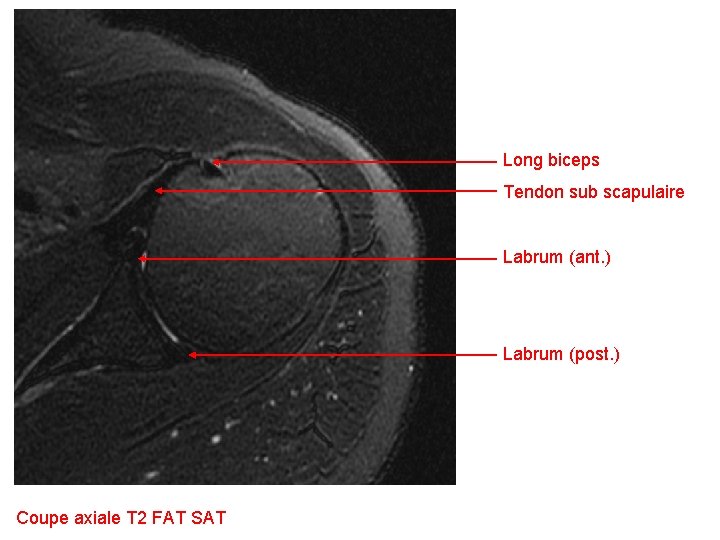 Long biceps Tendon sub scapulaire Labrum (ant. ) Labrum (post. ) Coupe axiale T