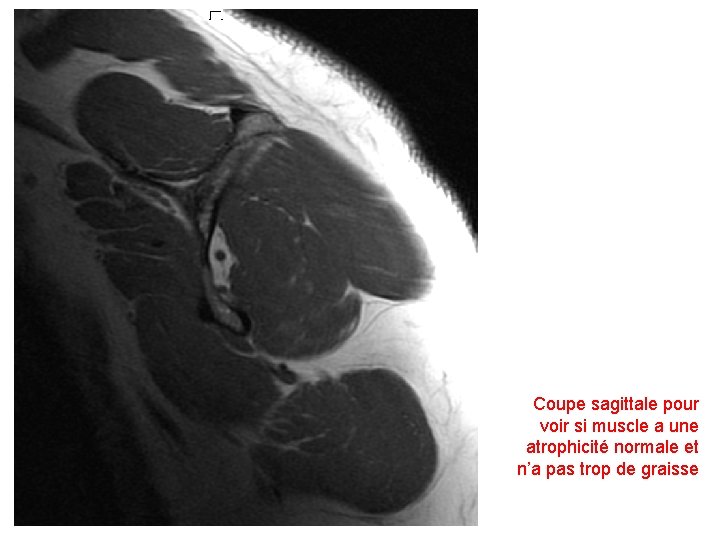 Coupe sagittale pour voir si muscle a une atrophicité normale et n’a pas trop